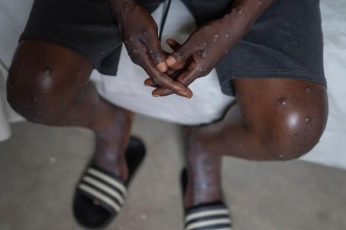 mpox_commune_de_limete_quartier_pakadjuma_epicentre_de_epidemie_jpg_711_473_1