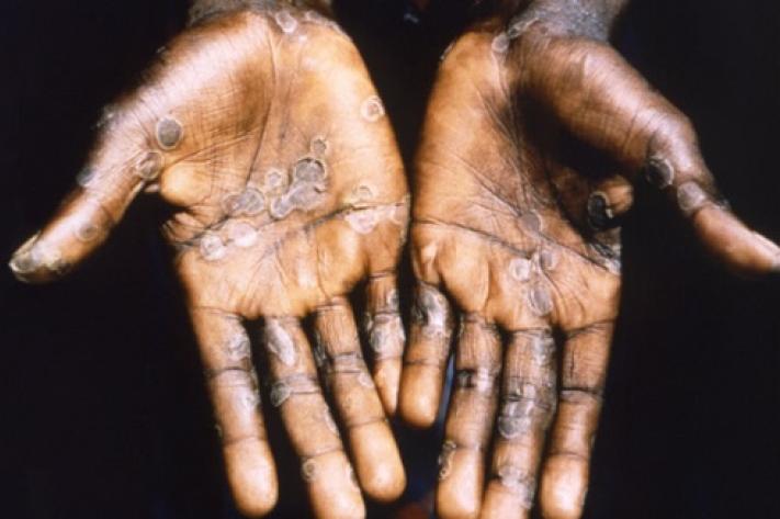mpox_la_course_aux_vaccins_deja_enclenchee_jpg_711_473_1